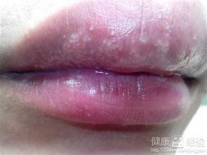 吃小白瓜嘴角起泡,嘴角起泡的甜蜜诱惑