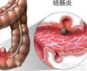 肠炎可以吃方瓜吗,营养与健康的双重守护